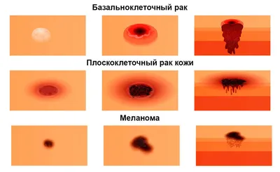 Дерматологи назвали вид рака кожи, который опаснее меланомы - Газета.Ru |  Новости