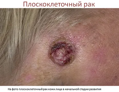 Сыпь на коже оказалась предвестником рака – Москва 24, 21.05.2021