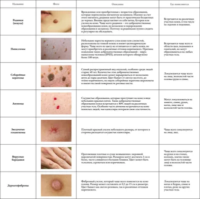 Признаки меланомы - как проверить родинку на наличие рака кожи | РБК Украина