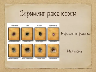 Это не укус комара: 7 признаков рака кожи, на которые никто не обращает  внимания