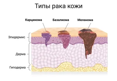 Рак кожи: симптомы, как выглядит, признаки, стадии, лечение