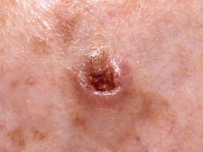 Воспалительные заболевания кожи и подкожной клетчатки: | Тихий омут | Дзен