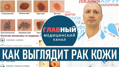 Рак кожи — Операция по методу Мооса в Израиле
