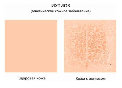 Базалиома. Базальноклеточный рак кожи. Базальноклеточная карцинома