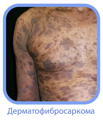 Рак кожи - ранние признаки | Стайлер