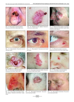 Как выглядит РАК КОЖИ (фото 1-8). Меланома, базалиома и плоскоклеточный рак  кожи - YouTube