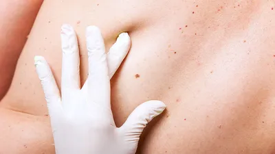 Рак кожи: симптомы и как его избежать — БРЮПРЕСС