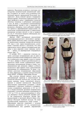 ПЛОСКОКЛЕТОЧНЫЙ РАК КОЖИ У БОЛЬНЫХ РЕЦЕССИВНЫМ ДИСТРОФИЧЕСКИМ БУЛЛЕЗНЫМ  ЭПИДЕРМОЛИЗОМ: СЛУЧАИ С АГРЕССИВНЫМ ТЕЧЕНИЕМ НОВООБРАЗОВАНИЯ
