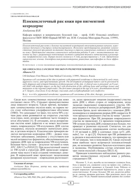 Плоскоклеточный рак кожи при пигментной ксеродерме – тема научной статьи по  клинической медицине читайте бесплатно текст научно-исследовательской  работы в электронной библиотеке КиберЛенинка