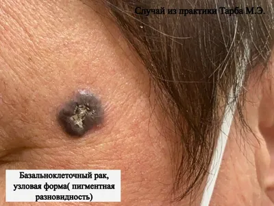 Рак губы | Министерство здравоохранения Забайкальского края