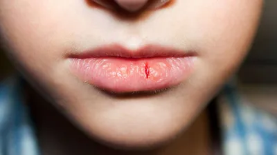 Рак губы: симптомы, классификация, признаки, проявления
