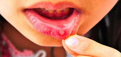 Рак губы: причины, симптомы, стадии, как выглядит, как определить