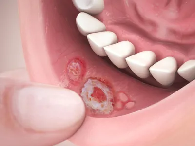 Блеск для губ может вызвать рак кожи