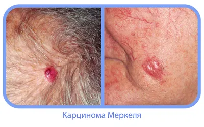 Плоскоклеточный рак кожи лица - Онкология - Судебная медицина от Forens.ru