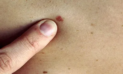 Рак кожи щеки | NEOPLASTY