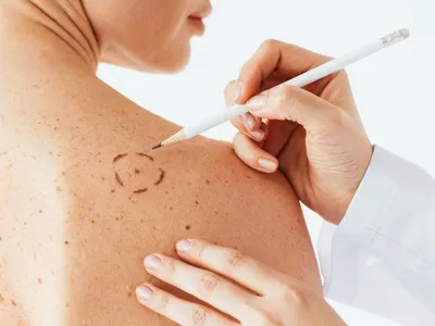 5 признаков рака кожи, которые на первых порах многие игнорируют. |  ПРАВДИВАЯ ОНКОЛОГИЯ | Дзен