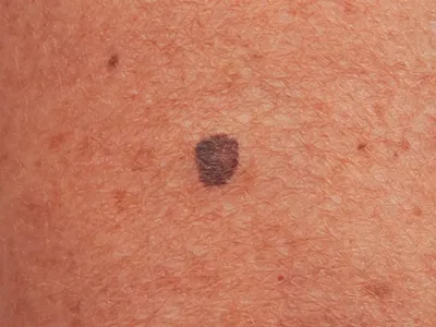 Базалиома - базальноклеточный рак кожи ( на лице, носу, спине, веке)