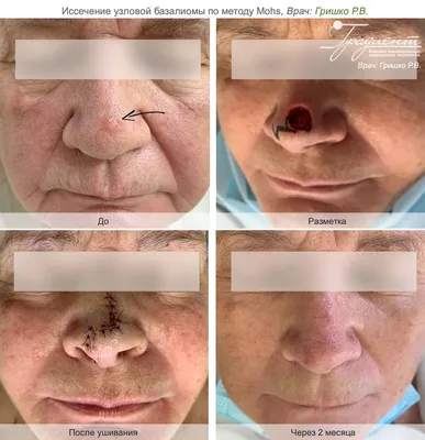 Рак кожи на кончике носа - базальноклеточная карцинома. | dr.dzhunkovskaya  | Дзен