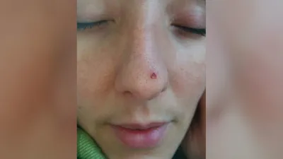 Рак кожи фото: женщина выдавливала прыщ на носу, который оказался  базально-клеточной карциномой — Здоровье