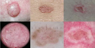 Онко Вики — Какие онкологические заболевания возникают на коже?