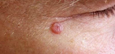 Плоскоклеточный рак кожи – симптомы, фото, лечение и диагностика