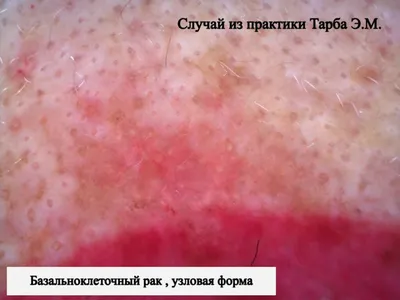 Лечение базалиомы кожи без рецидива – фотодинамическая терапия базалиомы