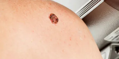 Базалиома - базальноклеточный рак кожи ( на лице, носу, спине, веке)