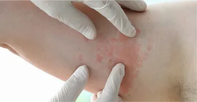 Заболевание кожи на дерматите рук Стоковое Изображение - изображение  насчитывающей здоровье, внимательность: 108050473