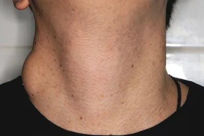 Крупным планом теги кожи на кожу человека на шее Стоковое Фото -  изображение насчитывающей доктор, рак: 197721116