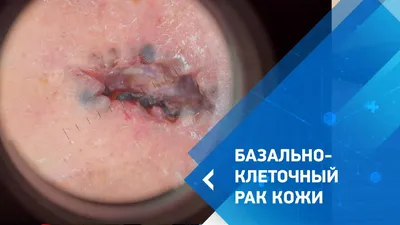 Рак шеи и головы - лечение и ранняя диагностика онкологии по доступной цене  в Москве | Медскан.
