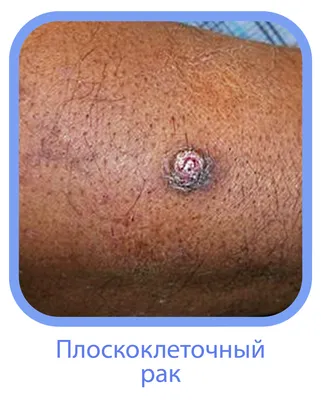 Ранние симптомы меланомы кожи – информация для пациентов — клиника  «Добробут»