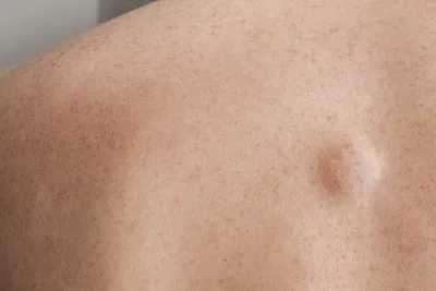 Это не укус комара: 7 признаков рака кожи, на которые никто не обращает  внимания