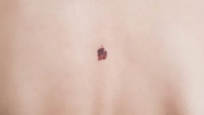 Первично-множественный рак кожи