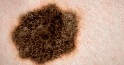 Рак кожи как обнаружить, советы дерматолога
