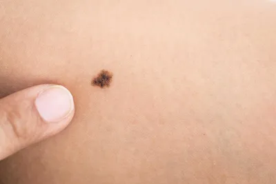Рак кожи – как он возникает и можно ли вылечить - Феникс