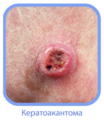 Онко Вики — Формы плоскоклеточного рака кожи