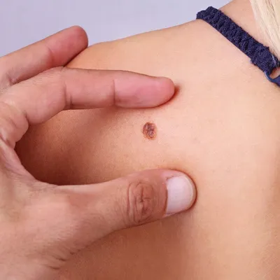 Рак кожи - как предотвратить, объясняет врач-дерматолог