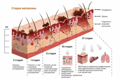 Лечение рака кожи: стадии заболевания, диагностика и методы терапии при  онкологии кожи