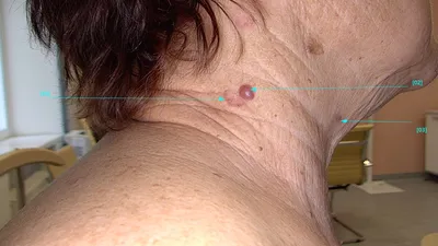 Начальная стадия меланомы стоковое изображение. изображение насчитывающей  злокачественно - 164029435