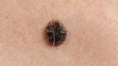 Ранний базальноклеточный рак кожи.