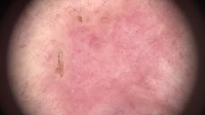 Немеланомный рак кожи: что это? | МЦ Лазерсвiт