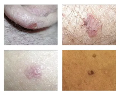 Рак кожи: симптомы, фото, диагностика и лечение