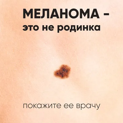 Как выглядит рак кожи и как распознать меланому или базалиому, фото  злокачественных новообразований на коже - 2 августа 2022 - chita.ru