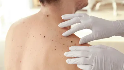 Четыре вида кожной сыпи, которые могут быть симптомами онкологии -  Рамблер/новости