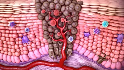 Диагностика рака кожи в Киеве - стоимость лечения | Brennerclinic