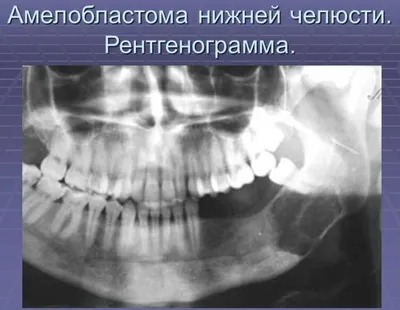 Рак ротоглотки - симптомы, признаки.