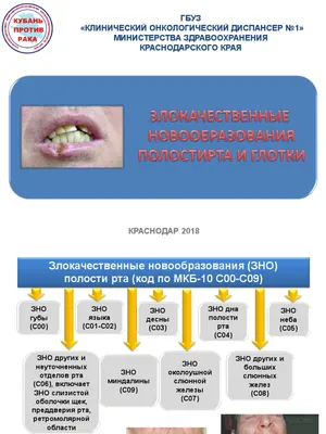 рак полости рта