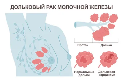 Дольковый рак молочной железы: симптомы, причины, лечение, прогноз