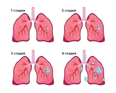 Что происходит на каждой стадии рака молочной железы? | Мedical Insider |  Дзен