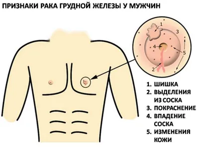 Рак груди бывает и у мужчин! Какие у него симптомы? | Онкология — не  приговор | Дзен